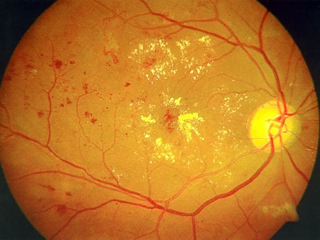 Retina & Vitreous Services